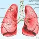 What Are the Chances of Lung Nodules Being Cancer?